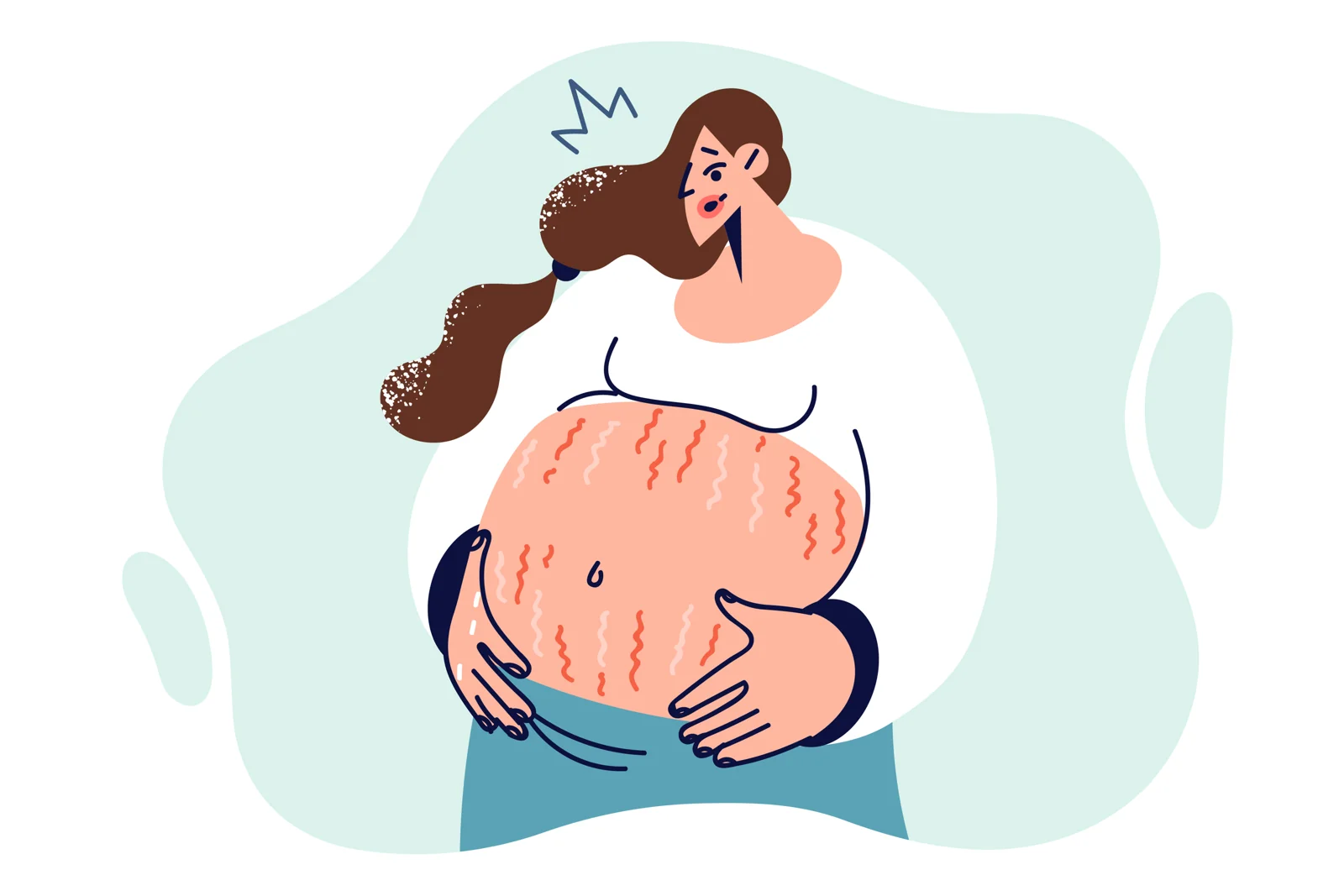 Illustration of a pregnant abdomen with stretch marks.
